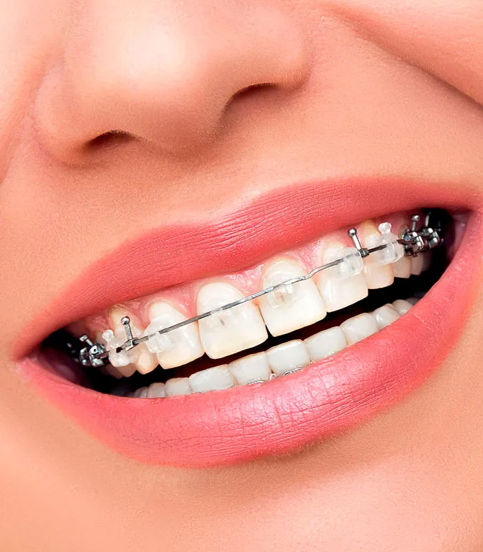 Primer plano de una sonrisa con brackets de ortodoncia