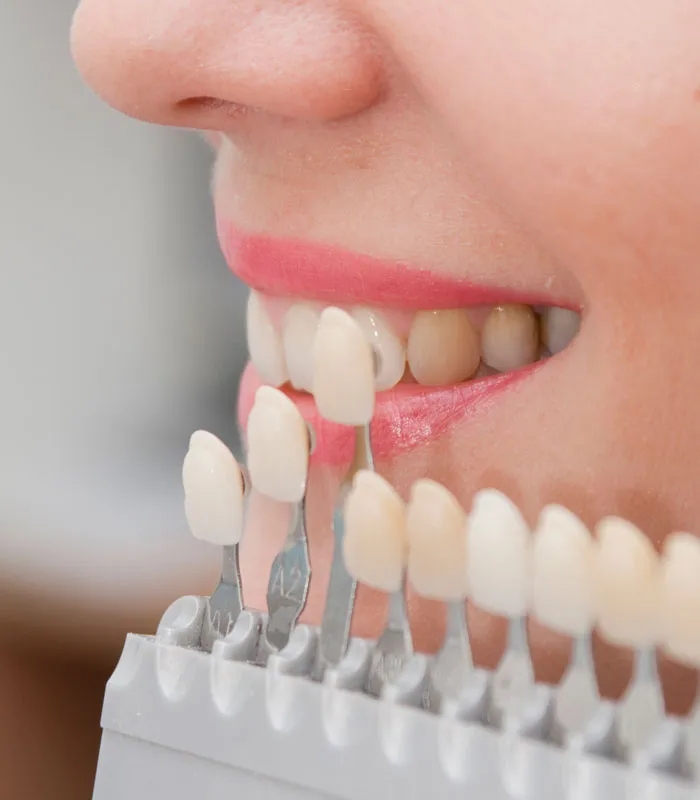 Guía de colores de prótesis dental comparada con la sonrisa de una paciente